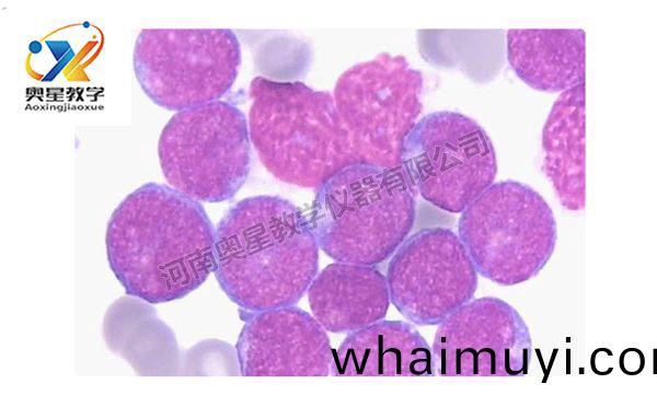 急性痳巴細(xi)胞白(bai)血病