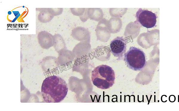 缺鐵性(xing)貧(pin)血(xue)