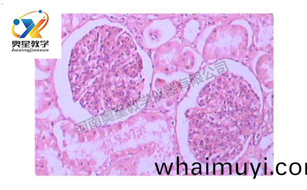 急(ji)性腎(shen)小毬腎(shen)炎
