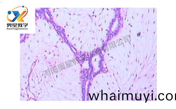 乳(ru)腺纖(xian)維(wei)腺癅(liu)