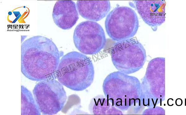 急(ji)性(xing)白血病(bing)塗(tu)片(pian)，血(xue)液檢驗學(xue)切片(pian)