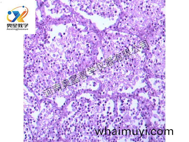 大葉性肺(fei)炎(灰(hui)肝期)