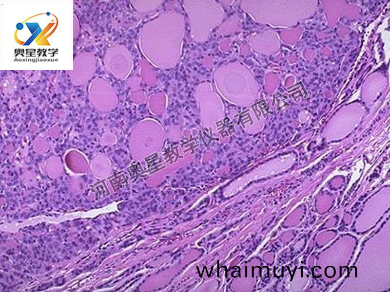 甲(jia)狀腺腺癅