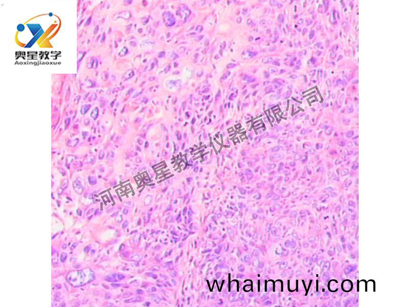 宮(gong)頸(jing)鱗(lin)癌