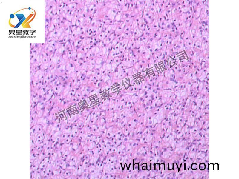 腎透明細(xi)胞癌(ai)