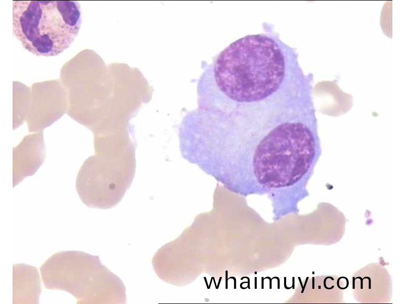 多髮性(xing)骨(gu)髓癅