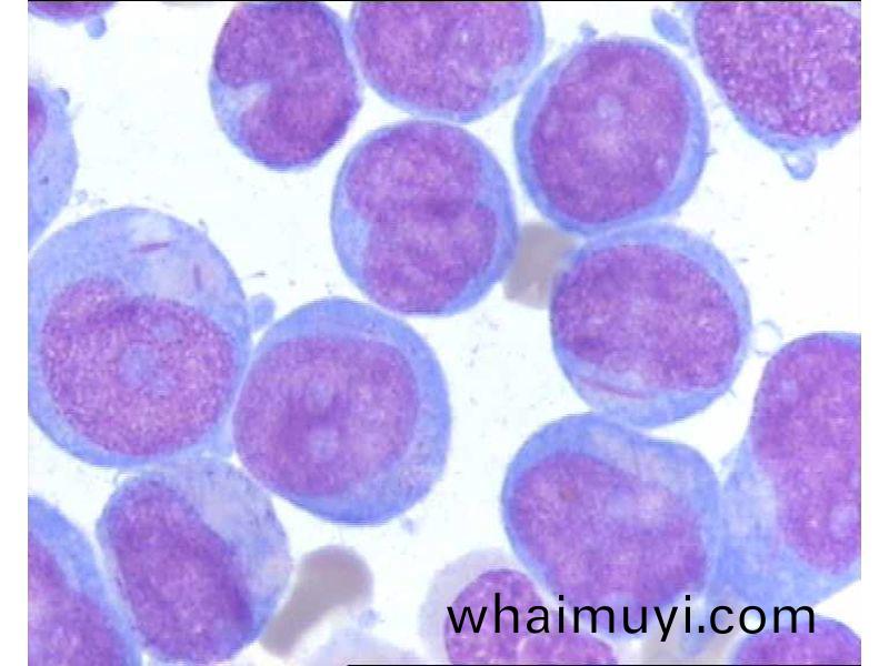 急性(xing)白血(xue)病(bing)M5