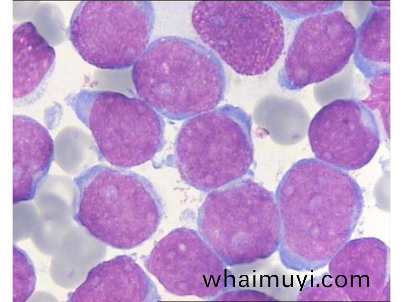 急性白(bai)血病(bing)M2