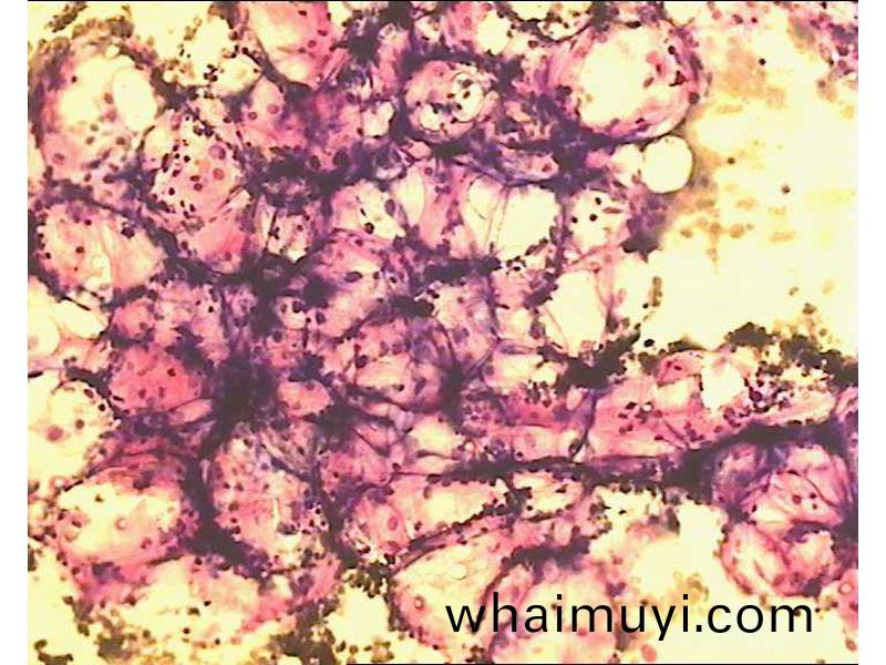 再(zai)生(sheng)障礙性貧(pin)血